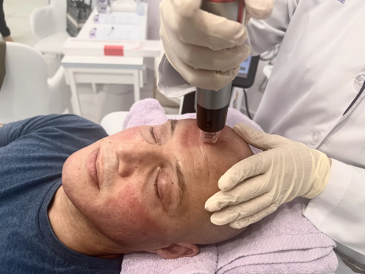 Genius RF Microneedling In Dubai- Lelara Aesthetic Clinic